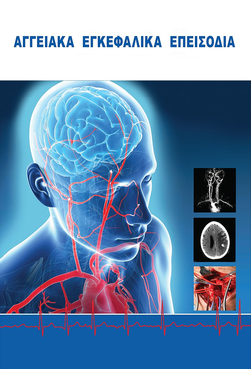Αγγειακά Εγκεφαλικά Επεισόδια